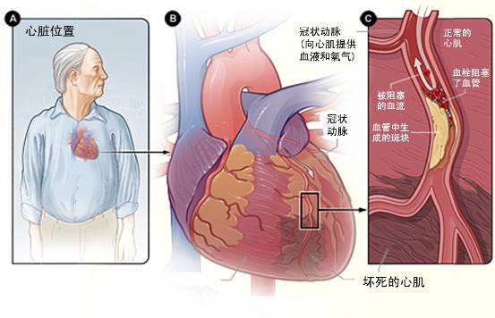 怎样治疗冠心病？(图3)