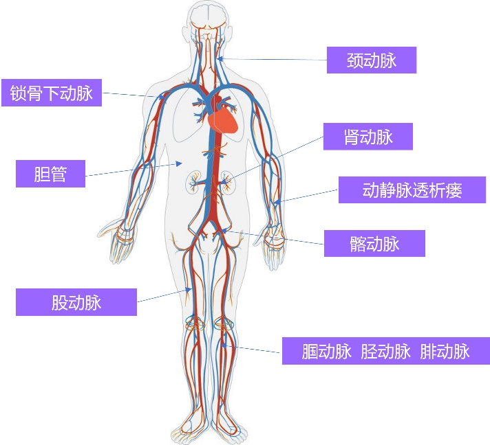 周游™ Voyaging™球囊扩张导管(图3)